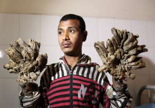 Bangladesh Tree man- India Tv - India TV Bangladesh Tree man- India Tv - India TV