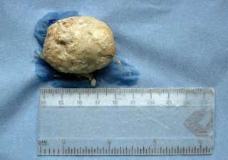 Bladder Infection, Stone, Doctor - India TV Bladder Infection, Stone, Doctor - India TV