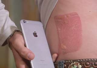 man was burned by his wet iPhone man was burned by his wet iPhone