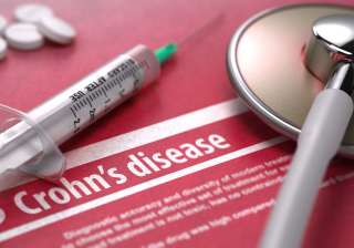 crohn disorder - India TV crohn disorder - India TV