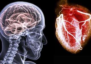 brain attacks as serious as heart attacks expert... brain attacks as serious as heart attacks expert...