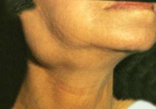 swollen neck glands may indicate cancer - India TV swollen neck glands may indicate cancer - India TV