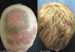 arthritis drug spurs hair growth in hairless man... arthritis drug spurs hair growth in hairless man...
