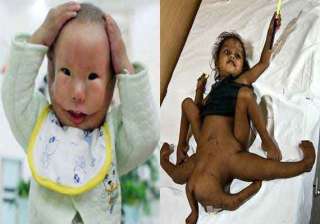 know people who have extra body parts - India TV know people who have extra body parts - India TV