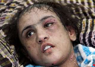 tortured afghan girl wants in laws jailed - India... tortured afghan girl wants in laws jailed - India...