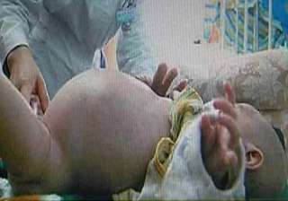 two year old boy gives birth to his twin brother... two year old boy gives birth to his twin brother...