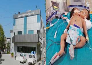 amazing conjoined twins in haryana have a single... amazing conjoined twins in haryana have a single...