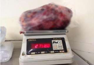 world s largest kidney removed from a patient in... world s largest kidney removed from a patient in...