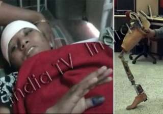 lucknow doctors perform surgery on arunima s... lucknow doctors perform surgery on arunima s...