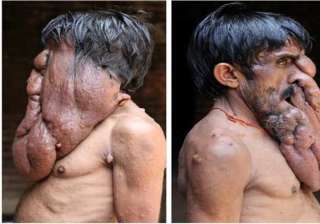 meet india s elephant man living in agony with a... meet india s elephant man living in agony with a...