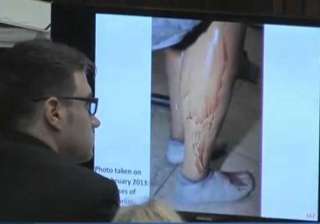pistorius photographed in bloodied prosthetics -... pistorius photographed in bloodied prosthetics -...