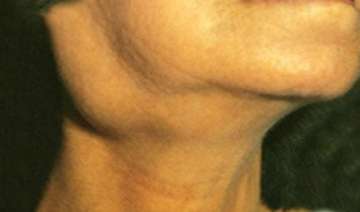 swollen neck glands may indicate cancer - India TV swollen neck glands may indicate cancer - India TV
