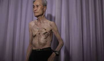 in pics nagasaki atomic bomb survivor shows his... in pics nagasaki atomic bomb survivor shows his...