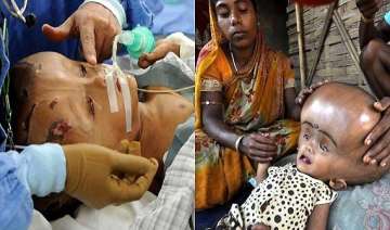 tripura girl with giant head syndrome roona gets... tripura girl with giant head syndrome roona gets...