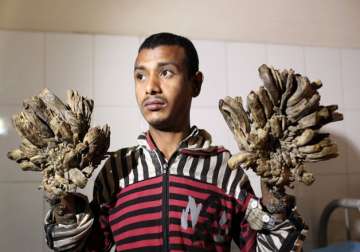 Bangladesh Tree man- India Tv - India TV Bangladesh Tree man- India Tv - India TV