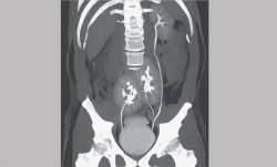 Man suffering from back problem finds out he has 3 kidneys